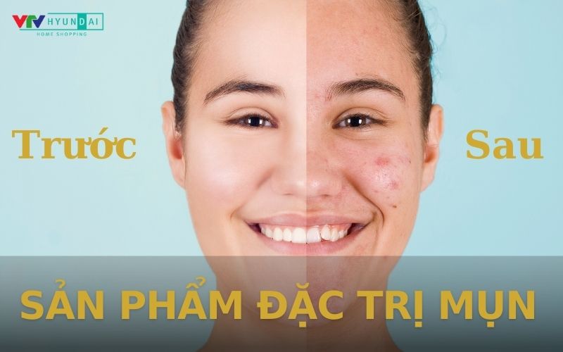 Chăm sóc da mặt bị mụn 8