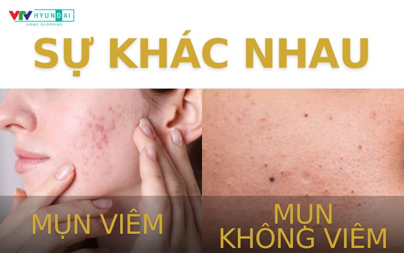 Chăm sóc da mặt bị mụn 2